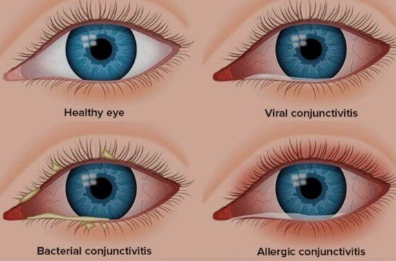 Comparison of healthy eye and infected eyes showing viral, bacterial, and allergic conjunctivitis for the Best Conjunctivitis Treatment in Sector 51, Gurugram.