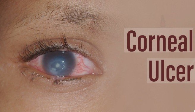 Best Treatment for Corneal Ulcers in Sector 51, Gurugram