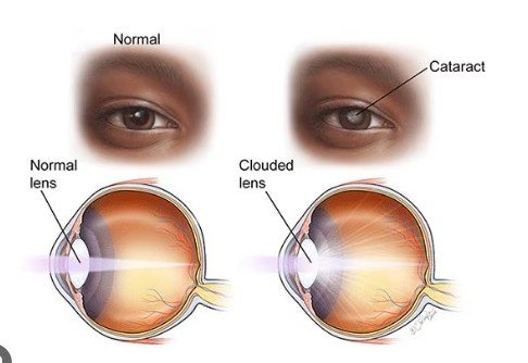 best treatment for cataract types in Sector 51, Gurugram