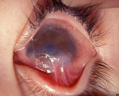 Best Chemical Injury in Eye Treatment in Sector 51, Gurugram