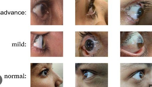 Best Eye Keratoconus Treatment in Sector 51, Gurugram