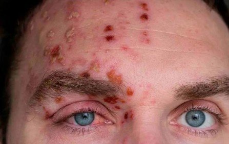 Best Herpes Zoster Ophthalmicus Care in Sector 51, Gurugram