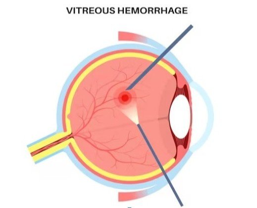 Best Vitreous Hemorrhage Treatment in Sector 46, Gurugram