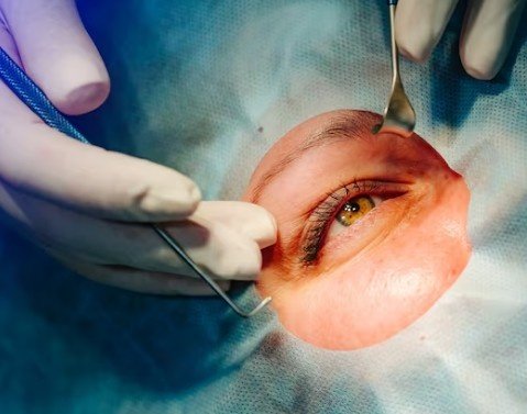 Pterygium Removal Treatment in Sector 50, Gurugram