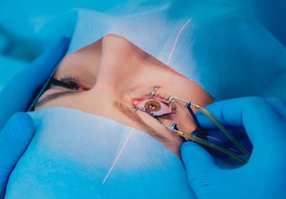 Best Refractive Surgery in Sector 51, Gurugram