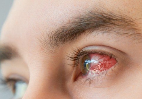 Damage Caused by Rubbing Eyes Treatment in Gurugram
