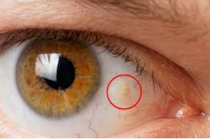 Best Doctor For pinguecula treatment in Gurgaon