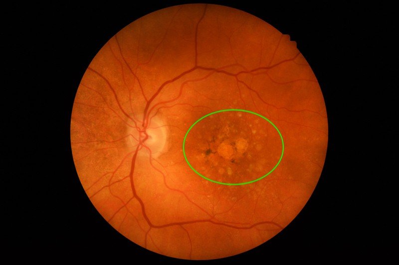 Macular Degeneration Treatment in Gurugram